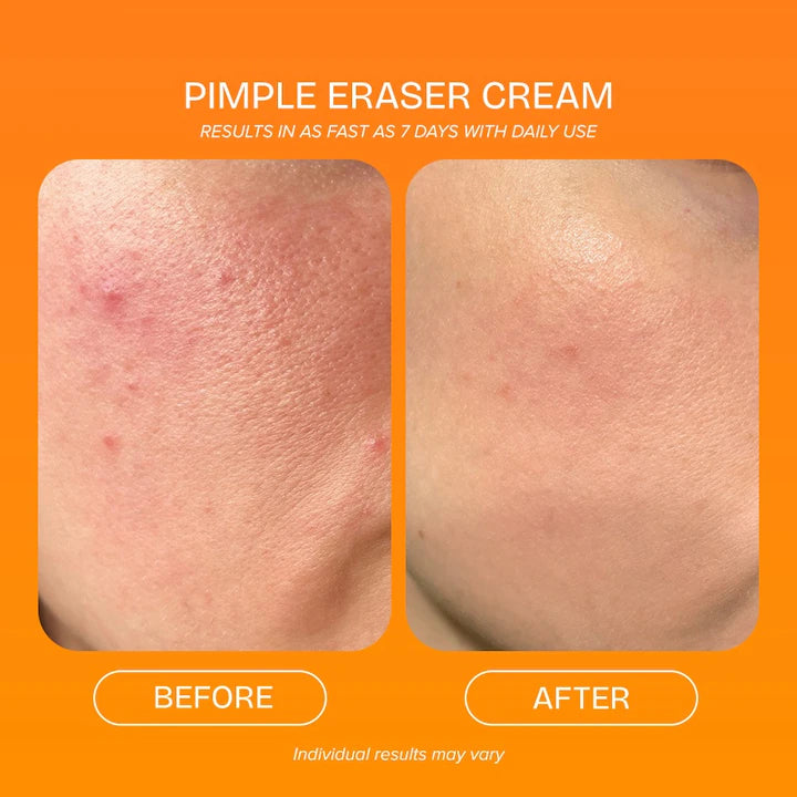 QUICKFX Pimple Eraser Active Spot Cream 30g