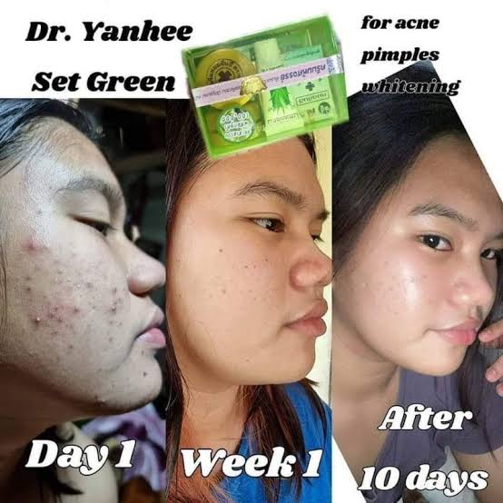Dr. Yanhee Facial Set (Anti-Acne)