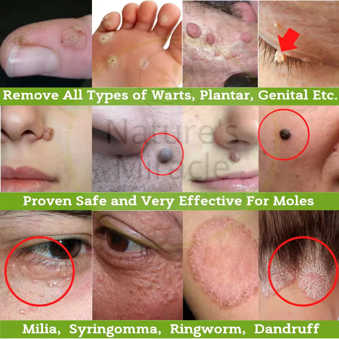 Nature’s Miracle Organic Warts Remover – 10ml (Kasoy Oil)