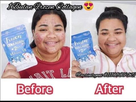 Frozen Collagen 2 in 1 Whitening x10